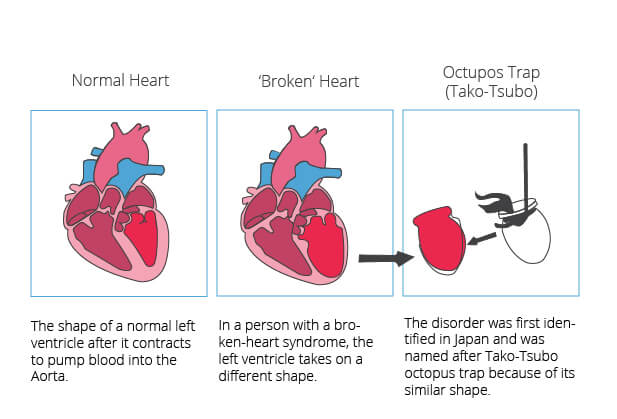 Broken Heart Syndrome: Tips On How To Detect This Fatal Heart Disease That's Affecting Women
