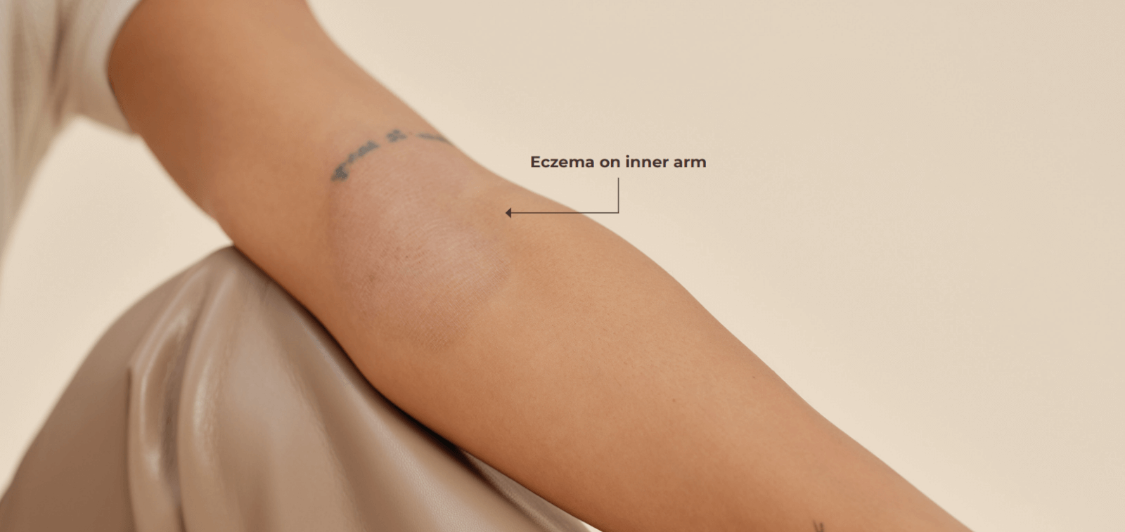 Aveeno® Canada’s New #Skinvisibility Visual Resource Spotlights Eczema on Diverse Skin Tones: Challenges exist when diagnosing eczema with non-Caucasian skin tones. Photo Credit: Aveeno® Canada