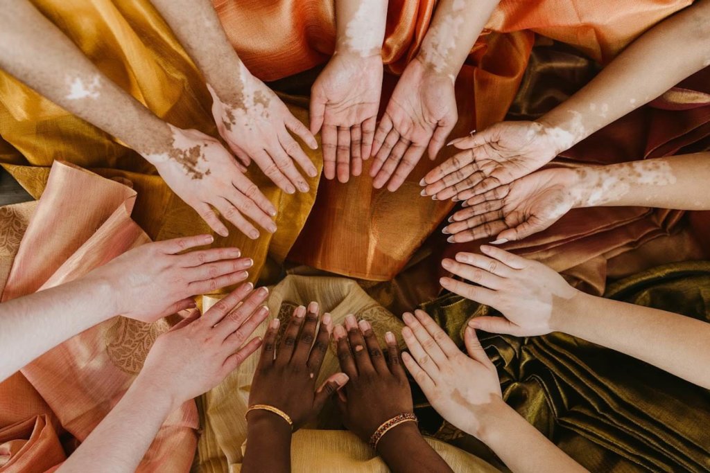 Fearless Women With Vitiligo Raise Awareness With A Fab Photoshoot